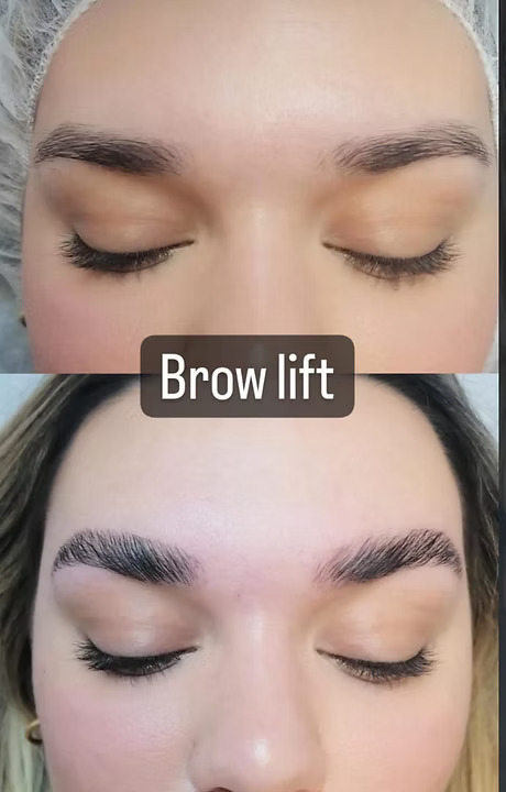 Brow-Lift